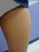 thigh%20(after)%20-%20thumbnail.jpg